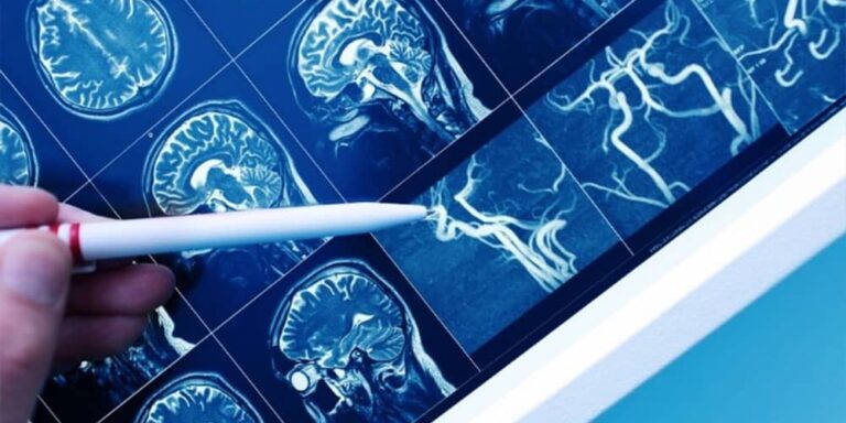 Prevenção ao AVC - Hospital Ipiranga